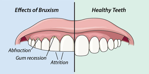 worn down teeth short teeth 