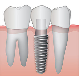 dental implants drummoyne dental practice