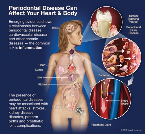 periodontal disease and general health