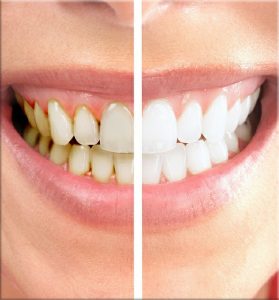veneers white teeth