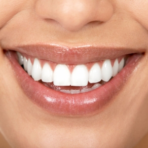 veneers at drummoyne