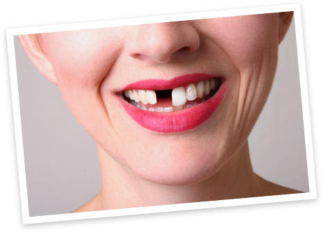 missing_tooth
