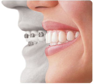 invisalign at drummoyne