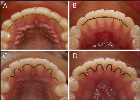 Life After Braces: Wire Vs Plastic Retainers