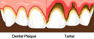 dental plaque and tartar