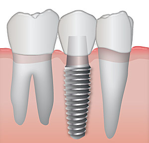 dental implant