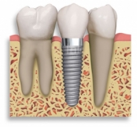 replacement of teeth at drummoyne