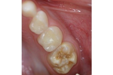 children's dentistry screening for hypomineralisation