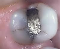 amalgam replacement