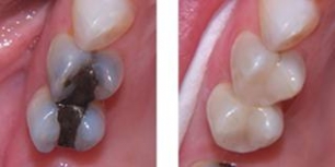 Replacing amalgam restorations at Drummoyne Dental Practice