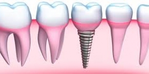 Dental Implants available at Drummoyne Dental Practice